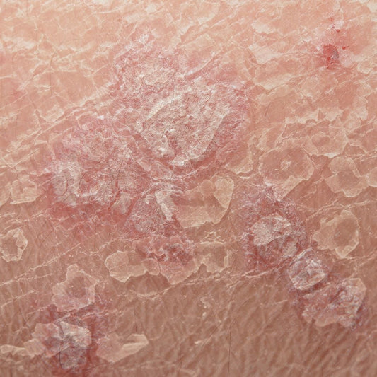 Psoriasis, Eczéma : Différences & Traitements