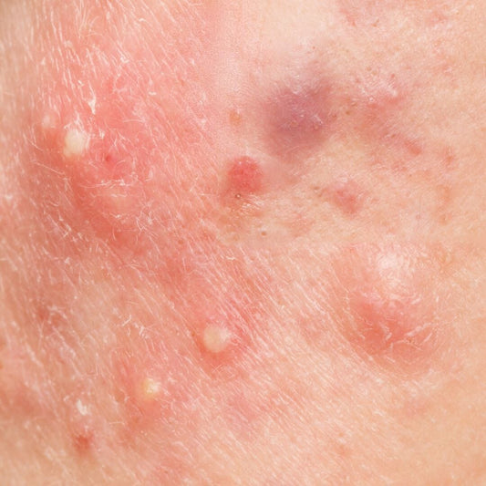 Acné : Symptôme, Causes, Types et Traitements
