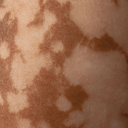 Vitiligo : Causes, Traitements & Témoignage